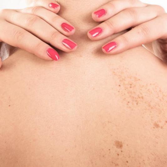 ¿Por qué se producen las manchas de la piel? Prevención y 3 Activos para tratarlas